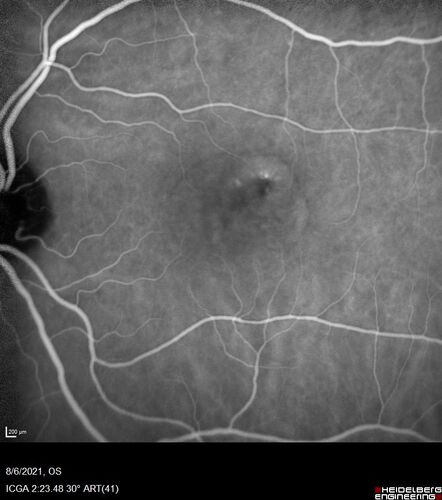 Central Serous Chorioretinopathy - Expanding hot spot - photodynamic laser
35 year old man with acute central serous chorioretinopathy.  The fluid got better then worse and the patient was treated with full strength juxtafoveal PDT and then got better.

