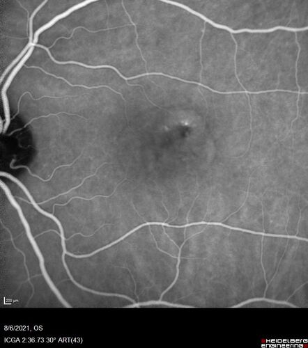 Central Serous Chorioretinopathy - Expanding hot spot - photodynamic laser
35 year old man with acute central serous chorioretinopathy.  The fluid got better then worse and the patient was treated with full strength juxtafoveal PDT and then got better.
