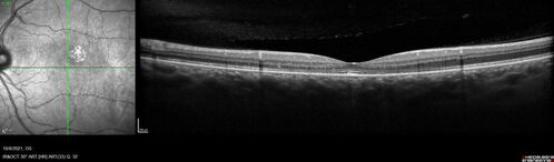 Central Serous Chorioretinopathy - Expanding hot spot - photodynamic laser
35 year old man with acute central serous chorioretinopathy.  The fluid got better then worse and the patient was treated with full strength juxtafoveal PDT and then got better.
