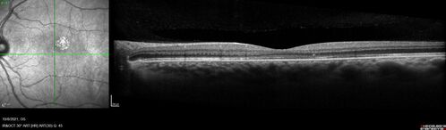 Central Serous Chorioretinopathy - Expanding hot spot - photodynamic laser
35 year old man with acute central serous chorioretinopathy.  The fluid got better then worse and the patient was treated with full strength juxtafoveal PDT and then got better.
