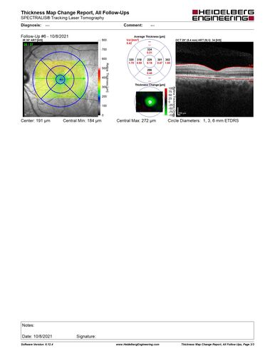 Central Serous Chorioretinopathy - Expanding hot spot - photodynamic laser
35 year old man with acute central serous chorioretinopathy.  The fluid got better then worse and the patient was treated with full strength juxtafoveal PDT and then got better.
