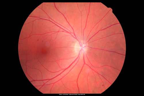 Central Serous Retinopathy - Female on steroids
35 year old female Noticed blurred vision when waking up in the morning.  Also, vision blacks out for a few seconds when she gets up quickly. About 3 months ago she had a history of intermittent vomiting.

VA 20/20 OD, 20/25 OS

MRI normal,  MRA showed lateral sinus thrombosis.  Lupus anticoagulant was positive
