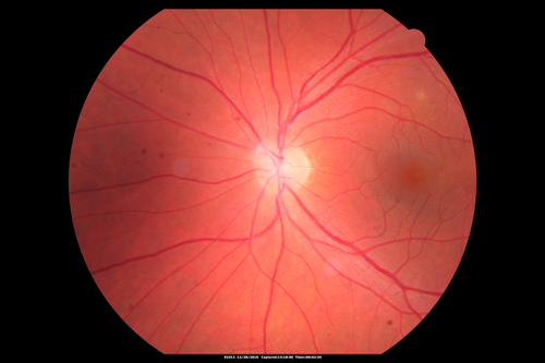 Central Serous Retinopathy - Female on steroids
35 year old female Noticed blurred vision when waking up in the morning.  Also, vision blacks out for a few seconds when she gets up quickly. About 3 months ago she had a history of intermittent vomiting.

VA 20/20 OD, 20/25 OS

MRI normal,  MRA showed lateral sinus thrombosis.  Lupus anticoagulant was positive
