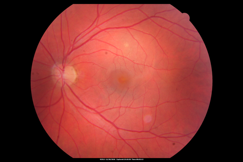 Central Serous Retinopathy - Female on steroids
35 year old female Noticed blurred vision when waking up in the morning.  Also, vision blacks out for a few seconds when she gets up quickly. About 3 months ago she had a history of intermittent vomiting.

VA 20/20 OD, 20/25 OS

MRI normal,  MRA showed lateral sinus thrombosis.  Lupus anticoagulant was positive

