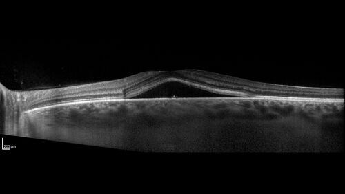 Central Serous Retinopathy - Female on steroids
35 year old female Noticed blurred vision when waking up in the morning.  Also, vision blacks out for a few seconds when she gets up quickly. About 3 months ago she had a history of intermittent vomiting.

VA 20/20 OD, 20/25 OS

MRI normal,  MRA showed lateral sinus thrombosis.  Lupus anticoagulant was positive
