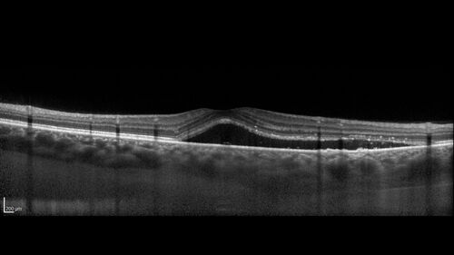 Central Serous Retinopathy - Female on steroids
35 year old female Noticed blurred vision when waking up in the morning.  Also, vision blacks out for a few seconds when she gets up quickly. About 3 months ago she had a history of intermittent vomiting.

VA 20/20 OD, 20/25 OS

MRI normal,  MRA showed lateral sinus thrombosis.  Lupus anticoagulant was positive

