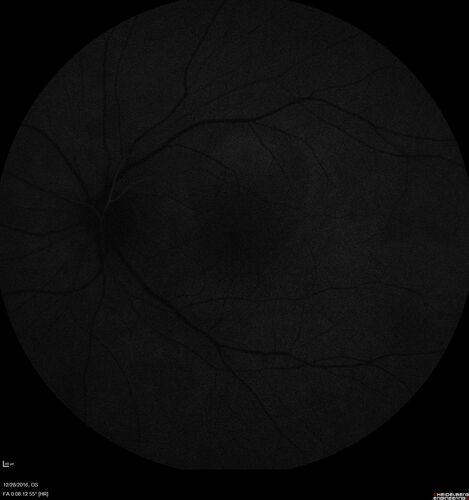 Central Serous Retinopathy - Female on steroids
35 year old female Noticed blurred vision when waking up in the morning.  Also, vision blacks out for a few seconds when she gets up quickly. About 3 months ago she had a history of intermittent vomiting.

VA 20/20 OD, 20/25 OS

MRI normal,  MRA showed lateral sinus thrombosis.  Lupus anticoagulant was positive
