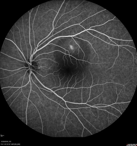 Central Serous Retinopathy - Female on steroids
35 year old female Noticed blurred vision when waking up in the morning.  Also, vision blacks out for a few seconds when she gets up quickly. About 3 months ago she had a history of intermittent vomiting.

VA 20/20 OD, 20/25 OS

MRI normal,  MRA showed lateral sinus thrombosis.  Lupus anticoagulant was positive
