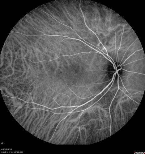 Central Serous Retinopathy - Female on steroids
35 year old female Noticed blurred vision when waking up in the morning.  Also, vision blacks out for a few seconds when she gets up quickly. About 3 months ago she had a history of intermittent vomiting.

VA 20/20 OD, 20/25 OS

MRI normal,  MRA showed lateral sinus thrombosis.  Lupus anticoagulant was positive
