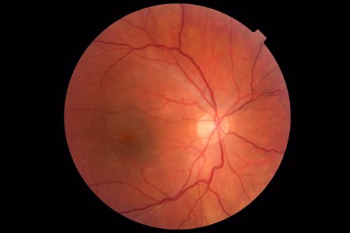 Acute Bilateral Central Serous Chorioretinopathy - Female - Smokestack
39 year old female She had no prior epsisodes of vision loss and then a week ago she noticed decreased vision in the right eye.  She has not had any health problems and she is not pregnant.  Phendimetrazine started 3 months ago.  She is not on steroids.   VA OD: sc20/63-1 NscJ16 VA OS: sc20/125-1 Dcc20/80 NscJ16 IOP: TP: OD:14 OS:14 Time:11:23 AM
