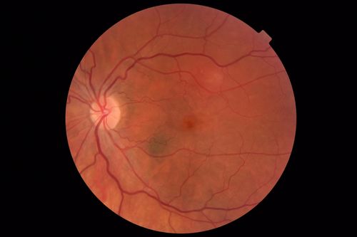 Acute Bilateral Central Serous Chorioretinopathy - Female - Smokestack
39 year old female She had no prior epsisodes of vision loss and then a week ago she noticed decreased vision in the right eye.  She has not had any health problems and she is not pregnant.  Phendimetrazine started 3 months ago.  She is not on steroids.   VA OD: sc20/63-1 NscJ16 VA OS: sc20/125-1 Dcc20/80 NscJ16 IOP: TP: OD:14 OS:14 Time:11:23 AM
