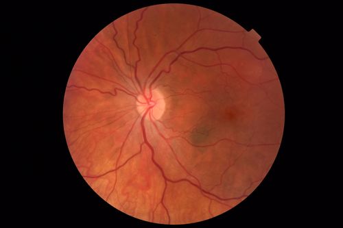 Acute Bilateral Central Serous Chorioretinopathy - Female - Smokestack
39 year old female She had no prior epsisodes of vision loss and then a week ago she noticed decreased vision in the right eye.  She has not had any health problems and she is not pregnant.  Phendimetrazine started 3 months ago.  She is not on steroids.   VA OD: sc20/63-1 NscJ16 VA OS: sc20/125-1 Dcc20/80 NscJ16 IOP: TP: OD:14 OS:14 Time:11:23 AM

