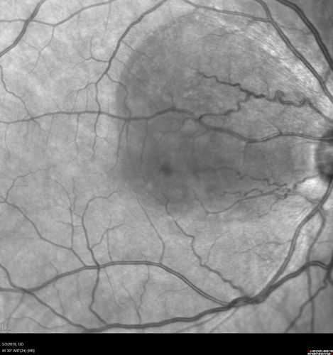 Acute Bilateral Central Serous Chorioretinopathy - Female - Smokestack
39 year old female She had no prior epsisodes of vision loss and then a week ago she noticed decreased vision in the right eye.  She has not had any health problems and she is not pregnant.  Phendimetrazine started 3 months ago.  She is not on steroids.   VA OD: sc20/63-1 NscJ16 VA OS: sc20/125-1 Dcc20/80 NscJ16 IOP: TP: OD:14 OS:14 Time:11:23 AM
