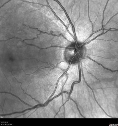 Acute Bilateral Central Serous Chorioretinopathy - Female - Smokestack
39 year old female She had no prior epsisodes of vision loss and then a week ago she noticed decreased vision in the right eye.  She has not had any health problems and she is not pregnant.  Phendimetrazine started 3 months ago.  She is not on steroids.   VA OD: sc20/63-1 NscJ16 VA OS: sc20/125-1 Dcc20/80 NscJ16 IOP: TP: OD:14 OS:14 Time:11:23 AM
