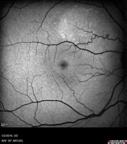 Acute Bilateral Central Serous Chorioretinopathy - Female - Smokestack
39 year old female She had no prior epsisodes of vision loss and then a week ago she noticed decreased vision in the right eye.  She has not had any health problems and she is not pregnant.  Phendimetrazine started 3 months ago.  She is not on steroids.   VA OD: sc20/63-1 NscJ16 VA OS: sc20/125-1 Dcc20/80 NscJ16 IOP: TP: OD:14 OS:14 Time:11:23 AM
