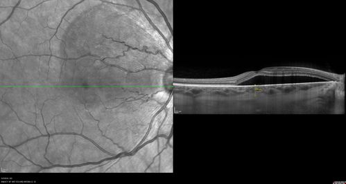 Acute Bilateral Central Serous Chorioretinopathy - Female - Smokestack
39 year old female She had no prior epsisodes of vision loss and then a week ago she noticed decreased vision in the right eye.  She has not had any health problems and she is not pregnant.  Phendimetrazine started 3 months ago.  She is not on steroids.   VA OD: sc20/63-1 NscJ16 VA OS: sc20/125-1 Dcc20/80 NscJ16 IOP: TP: OD:14 OS:14 Time:11:23 AM
