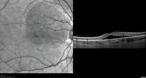 Acute Bilateral Central Serous Chorioretinopathy - Female - Smokestack
39 year old female She had no prior epsisodes of vision loss and then a week ago she noticed decreased vision in the right eye.  She has not had any health problems and she is not pregnant.  Phendimetrazine started 3 months ago.  She is not on steroids.   VA OD: sc20/63-1 NscJ16 VA OS: sc20/125-1 Dcc20/80 NscJ16 IOP: TP: OD:14 OS:14 Time:11:23 AM
