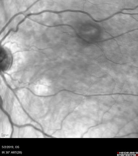 Acute Bilateral Central Serous Chorioretinopathy - Female - Smokestack
39 year old female She had no prior epsisodes of vision loss and then a week ago she noticed decreased vision in the right eye.  She has not had any health problems and she is not pregnant.  Phendimetrazine started 3 months ago.  She is not on steroids.   VA OD: sc20/63-1 NscJ16 VA OS: sc20/125-1 Dcc20/80 NscJ16 IOP: TP: OD:14 OS:14 Time:11:23 AM
