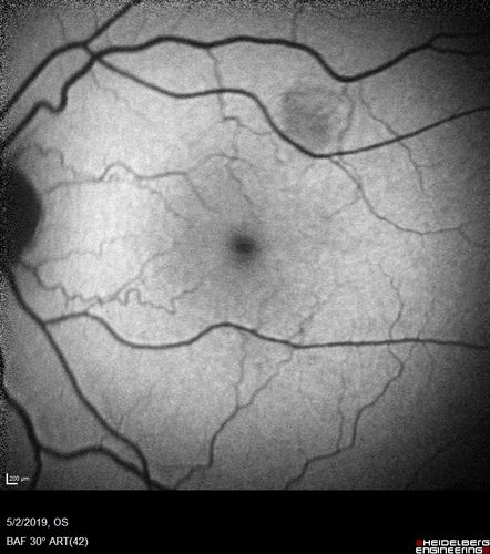 Acute Bilateral Central Serous Chorioretinopathy - Female - Smokestack
39 year old female She had no prior epsisodes of vision loss and then a week ago she noticed decreased vision in the right eye.  She has not had any health problems and she is not pregnant.  Phendimetrazine started 3 months ago.  She is not on steroids.   VA OD: sc20/63-1 NscJ16 VA OS: sc20/125-1 Dcc20/80 NscJ16 IOP: TP: OD:14 OS:14 Time:11:23 AM
