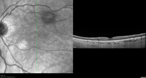 Acute Bilateral Central Serous Chorioretinopathy - Female - Smokestack
39 year old female She had no prior epsisodes of vision loss and then a week ago she noticed decreased vision in the right eye.  She has not had any health problems and she is not pregnant.  Phendimetrazine started 3 months ago.  She is not on steroids.   VA OD: sc20/63-1 NscJ16 VA OS: sc20/125-1 Dcc20/80 NscJ16 IOP: TP: OD:14 OS:14 Time:11:23 AM
