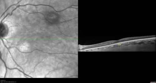 Acute Bilateral Central Serous Chorioretinopathy - Female - Smokestack
39 year old female She had no prior epsisodes of vision loss and then a week ago she noticed decreased vision in the right eye.  She has not had any health problems and she is not pregnant.  Phendimetrazine started 3 months ago.  She is not on steroids.   VA OD: sc20/63-1 NscJ16 VA OS: sc20/125-1 Dcc20/80 NscJ16 IOP: TP: OD:14 OS:14 Time:11:23 AM
