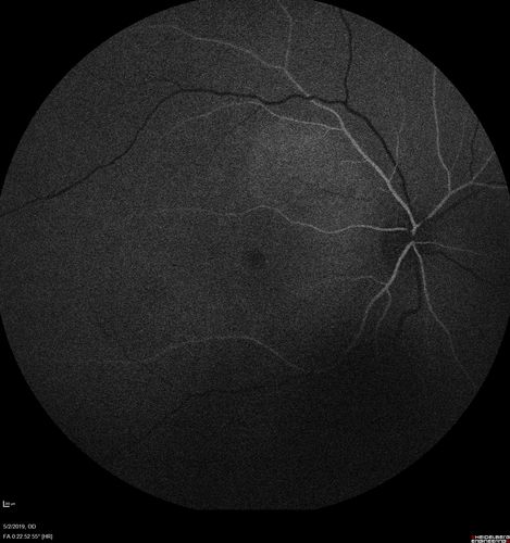 Acute Bilateral Central Serous Chorioretinopathy - Female - Smokestack
39 year old female She had no prior epsisodes of vision loss and then a week ago she noticed decreased vision in the right eye.  She has not had any health problems and she is not pregnant.  Phendimetrazine started 3 months ago.  She is not on steroids.   VA OD: sc20/63-1 NscJ16 VA OS: sc20/125-1 Dcc20/80 NscJ16 IOP: TP: OD:14 OS:14 Time:11:23 AM
