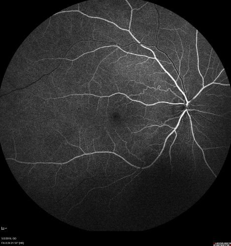 Acute Bilateral Central Serous Chorioretinopathy - Female - Smokestack
39 year old female She had no prior epsisodes of vision loss and then a week ago she noticed decreased vision in the right eye.  She has not had any health problems and she is not pregnant.  Phendimetrazine started 3 months ago.  She is not on steroids.   VA OD: sc20/63-1 NscJ16 VA OS: sc20/125-1 Dcc20/80 NscJ16 IOP: TP: OD:14 OS:14 Time:11:23 AM
