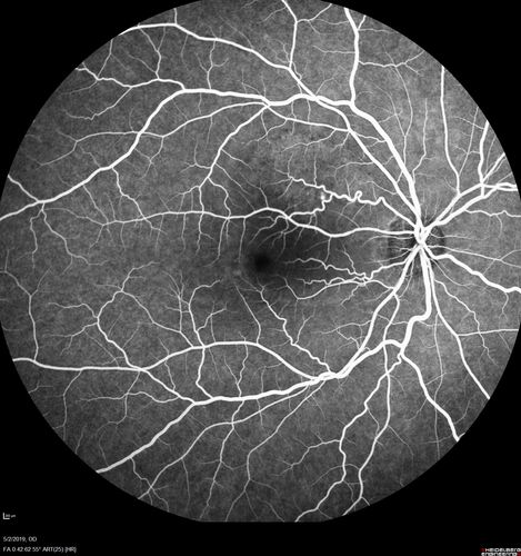 Acute Bilateral Central Serous Chorioretinopathy - Female - Smokestack
39 year old female She had no prior epsisodes of vision loss and then a week ago she noticed decreased vision in the right eye.  She has not had any health problems and she is not pregnant.  Phendimetrazine started 3 months ago.  She is not on steroids.   VA OD: sc20/63-1 NscJ16 VA OS: sc20/125-1 Dcc20/80 NscJ16 IOP: TP: OD:14 OS:14 Time:11:23 AM

