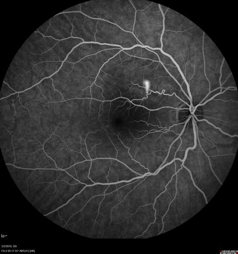 Acute Bilateral Central Serous Chorioretinopathy - Female - Smokestack
39 year old female She had no prior epsisodes of vision loss and then a week ago she noticed decreased vision in the right eye.  She has not had any health problems and she is not pregnant.  Phendimetrazine started 3 months ago.  She is not on steroids.   VA OD: sc20/63-1 NscJ16 VA OS: sc20/125-1 Dcc20/80 NscJ16 IOP: TP: OD:14 OS:14 Time:11:23 AM
