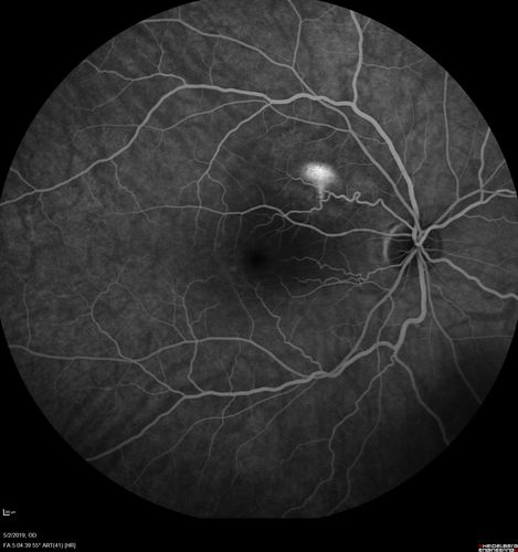 Acute Bilateral Central Serous Chorioretinopathy - Female - Smokestack
39 year old female She had no prior epsisodes of vision loss and then a week ago she noticed decreased vision in the right eye.  She has not had any health problems and she is not pregnant.  Phendimetrazine started 3 months ago.  She is not on steroids.   VA OD: sc20/63-1 NscJ16 VA OS: sc20/125-1 Dcc20/80 NscJ16 IOP: TP: OD:14 OS:14 Time:11:23 AM
