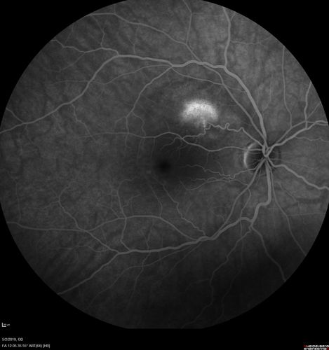 Acute Bilateral Central Serous Chorioretinopathy - Female - Smokestack
39 year old female She had no prior epsisodes of vision loss and then a week ago she noticed decreased vision in the right eye.  She has not had any health problems and she is not pregnant.  Phendimetrazine started 3 months ago.  She is not on steroids.   VA OD: sc20/63-1 NscJ16 VA OS: sc20/125-1 Dcc20/80 NscJ16 IOP: TP: OD:14 OS:14 Time:11:23 AM

