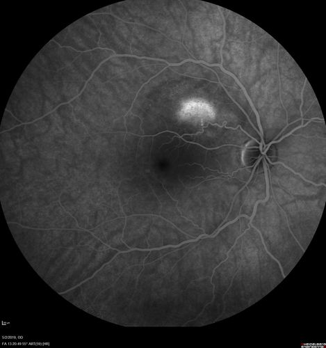 Acute Bilateral Central Serous Chorioretinopathy - Female - Smokestack
39 year old female She had no prior epsisodes of vision loss and then a week ago she noticed decreased vision in the right eye.  She has not had any health problems and she is not pregnant.  Phendimetrazine started 3 months ago.  She is not on steroids.   VA OD: sc20/63-1 NscJ16 VA OS: sc20/125-1 Dcc20/80 NscJ16 IOP: TP: OD:14 OS:14 Time:11:23 AM
