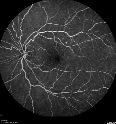 Acute Bilateral Central Serous Chorioretinopathy - Female - Smokestack
39 year old female She had no prior epsisodes of vision loss and then a week ago she noticed decreased vision in the right eye.  She has not had any health problems and she is not pregnant.  Phendimetrazine started 3 months ago.  She is not on steroids.   VA OD: sc20/63-1 NscJ16 VA OS: sc20/125-1 Dcc20/80 NscJ16 IOP: TP: OD:14 OS:14 Time:11:23 AM

