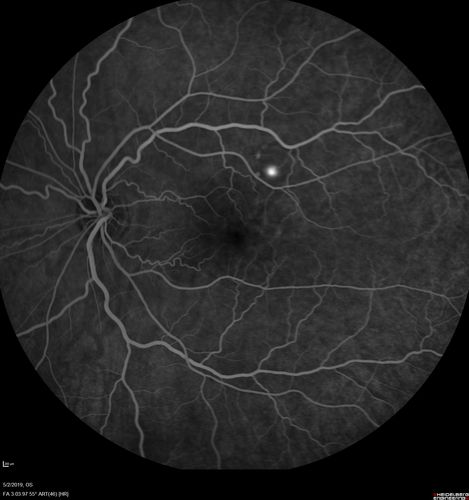 Acute Bilateral Central Serous Chorioretinopathy - Female - Smokestack
39 year old female She had no prior epsisodes of vision loss and then a week ago she noticed decreased vision in the right eye.  She has not had any health problems and she is not pregnant.  Phendimetrazine started 3 months ago.  She is not on steroids.   VA OD: sc20/63-1 NscJ16 VA OS: sc20/125-1 Dcc20/80 NscJ16 IOP: TP: OD:14 OS:14 Time:11:23 AM
