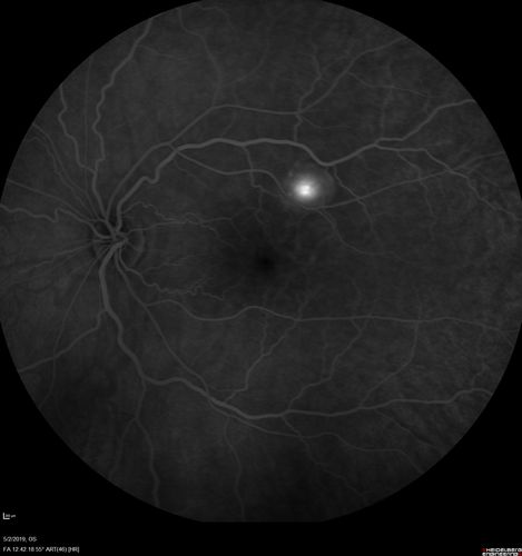 Acute Bilateral Central Serous Chorioretinopathy - Female - Smokestack
39 year old female She had no prior epsisodes of vision loss and then a week ago she noticed decreased vision in the right eye.  She has not had any health problems and she is not pregnant.  Phendimetrazine started 3 months ago.  She is not on steroids.   VA OD: sc20/63-1 NscJ16 VA OS: sc20/125-1 Dcc20/80 NscJ16 IOP: TP: OD:14 OS:14 Time:11:23 AM
