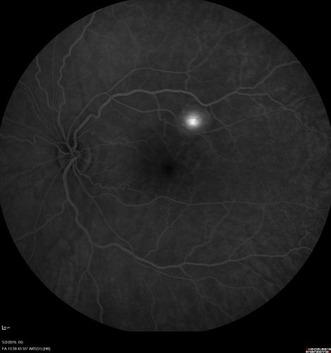 Acute Bilateral Central Serous Chorioretinopathy - Female - Smokestack
39 year old female She had no prior epsisodes of vision loss and then a week ago she noticed decreased vision in the right eye.  She has not had any health problems and she is not pregnant.  Phendimetrazine started 3 months ago.  She is not on steroids.   VA OD: sc20/63-1 NscJ16 VA OS: sc20/125-1 Dcc20/80 NscJ16 IOP: TP: OD:14 OS:14 Time:11:23 AM
