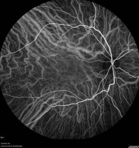 Acute Bilateral Central Serous Chorioretinopathy - Female - Smokestack
39 year old female She had no prior epsisodes of vision loss and then a week ago she noticed decreased vision in the right eye.  She has not had any health problems and she is not pregnant.  Phendimetrazine started 3 months ago.  She is not on steroids.   VA OD: sc20/63-1 NscJ16 VA OS: sc20/125-1 Dcc20/80 NscJ16 IOP: TP: OD:14 OS:14 Time:11:23 AM
