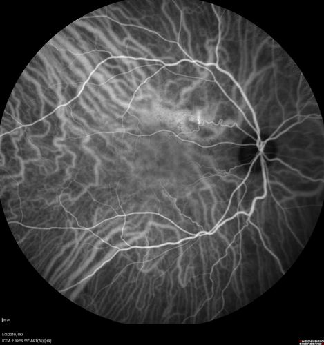 Acute Bilateral Central Serous Chorioretinopathy - Female - Smokestack
39 year old female She had no prior epsisodes of vision loss and then a week ago she noticed decreased vision in the right eye.  She has not had any health problems and she is not pregnant.  Phendimetrazine started 3 months ago.  She is not on steroids.   VA OD: sc20/63-1 NscJ16 VA OS: sc20/125-1 Dcc20/80 NscJ16 IOP: TP: OD:14 OS:14 Time:11:23 AM
