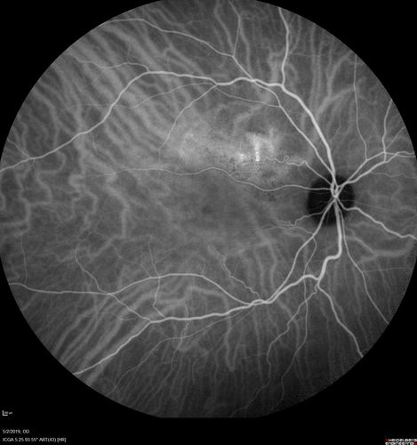 Acute Bilateral Central Serous Chorioretinopathy - Female - Smokestack
39 year old female She had no prior epsisodes of vision loss and then a week ago she noticed decreased vision in the right eye.  She has not had any health problems and she is not pregnant.  Phendimetrazine started 3 months ago.  She is not on steroids.   VA OD: sc20/63-1 NscJ16 VA OS: sc20/125-1 Dcc20/80 NscJ16 IOP: TP: OD:14 OS:14 Time:11:23 AM
