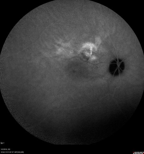 Acute Bilateral Central Serous Chorioretinopathy - Female - Smokestack
39 year old female She had no prior epsisodes of vision loss and then a week ago she noticed decreased vision in the right eye.  She has not had any health problems and she is not pregnant.  Phendimetrazine started 3 months ago.  She is not on steroids.   VA OD: sc20/63-1 NscJ16 VA OS: sc20/125-1 Dcc20/80 NscJ16 IOP: TP: OD:14 OS:14 Time:11:23 AM
