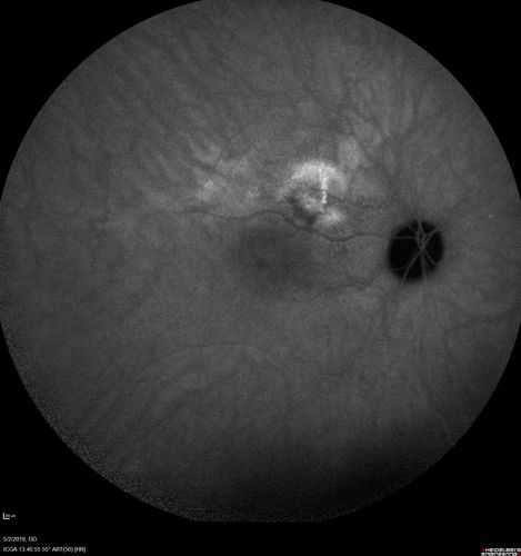 Acute Bilateral Central Serous Chorioretinopathy - Female - Smokestack
39 year old female She had no prior epsisodes of vision loss and then a week ago she noticed decreased vision in the right eye.  She has not had any health problems and she is not pregnant.  Phendimetrazine started 3 months ago.  She is not on steroids.   VA OD: sc20/63-1 NscJ16 VA OS: sc20/125-1 Dcc20/80 NscJ16 IOP: TP: OD:14 OS:14 Time:11:23 AM

