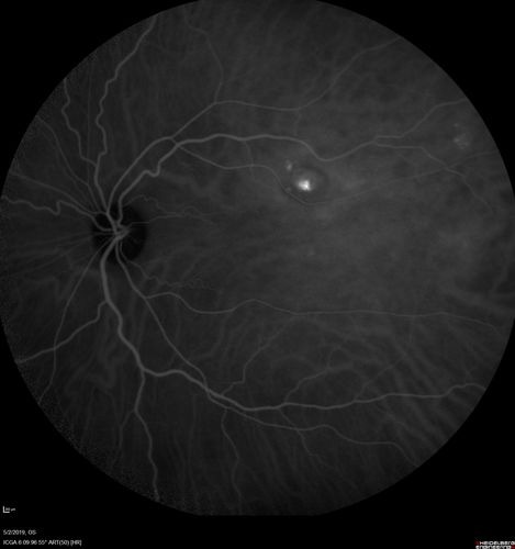 Acute Bilateral Central Serous Chorioretinopathy - Female - Smokestack
39 year old female She had no prior epsisodes of vision loss and then a week ago she noticed decreased vision in the right eye.  She has not had any health problems and she is not pregnant.  Phendimetrazine started 3 months ago.  She is not on steroids.   VA OD: sc20/63-1 NscJ16 VA OS: sc20/125-1 Dcc20/80 NscJ16 IOP: TP: OD:14 OS:14 Time:11:23 AM
