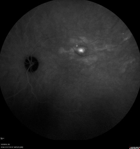 Acute Bilateral Central Serous Chorioretinopathy - Female - Smokestack
39 year old female She had no prior epsisodes of vision loss and then a week ago she noticed decreased vision in the right eye.  She has not had any health problems and she is not pregnant.  Phendimetrazine started 3 months ago.  She is not on steroids.   VA OD: sc20/63-1 NscJ16 VA OS: sc20/125-1 Dcc20/80 NscJ16 IOP: TP: OD:14 OS:14 Time:11:23 AM
