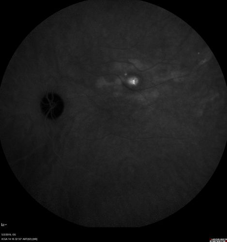Acute Bilateral Central Serous Chorioretinopathy - Female - Smokestack
39 year old female She had no prior epsisodes of vision loss and then a week ago she noticed decreased vision in the right eye.  She has not had any health problems and she is not pregnant.  Phendimetrazine started 3 months ago.  She is not on steroids.   VA OD: sc20/63-1 NscJ16 VA OS: sc20/125-1 Dcc20/80 NscJ16 IOP: TP: OD:14 OS:14 Time:11:23 AM
