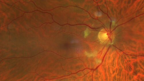 Cotton Wool Spots following cardio-pulmonary bypass
The patient had emergency thoracotomy about 3 weeks ago he had an aortic dissection with a root aneurysm. It had dissected down to the iliacs. The patient had a thoracotomy and aortic valve replacement and large aortic graft.
