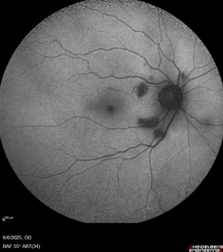Cotton Wool Spots following cardio-pulmonary bypass
The patient had emergency thoracotomy about 3 weeks ago he had an aortic dissection with a root aneurysm. It had dissected down to the iliacs. The patient had a thoracotomy and aortic valve replacement and large aortic graft.
