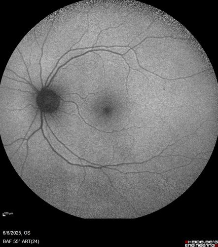 Cotton Wool Spots following cardio-pulmonary bypass
The patient had emergency thoracotomy about 3 weeks ago he had an aortic dissection with a root aneurysm. It had dissected down to the iliacs. The patient had a thoracotomy and aortic valve replacement and large aortic graft.
