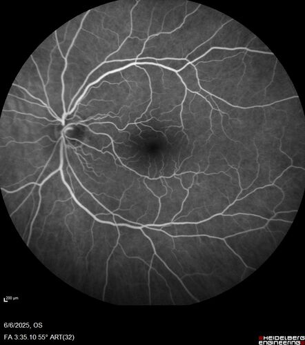 Cotton Wool Spots following cardio-pulmonary bypass
The patient had emergency thoracotomy about 3 weeks ago he had an aortic dissection with a root aneurysm. It had dissected down to the iliacs. The patient had a thoracotomy and aortic valve replacement and large aortic graft.
