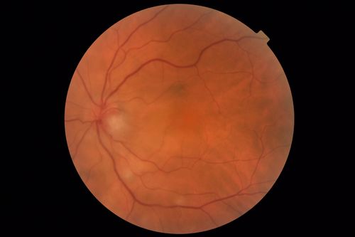 Neuroretinitis and Multifocal Retinitis
62 year old female with vision loss in the left eye to 20/160. Positive Bartonellas IgG.  Vision recovered in 2 months.  She was treated with Oral Erythromycin BID for 2 weeks.
