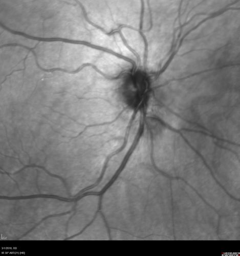 Neuroretinitis and Multifocal Retinitis
62 year old female with vision loss in the left eye to 20/160. Positive Bartonellas IgG.  Vision recovered in 2 months.  She was treated with Oral Erythromycin BID for 2 weeks.

